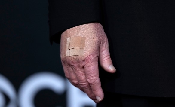 A bandage is seen on the hand of President Donald Trump while he walks the red carpet before the 48th Kennedy Center Honors, Sunday, Dec. 7, 2025, at the John F. Kennedy Center for the Performing Arts ...