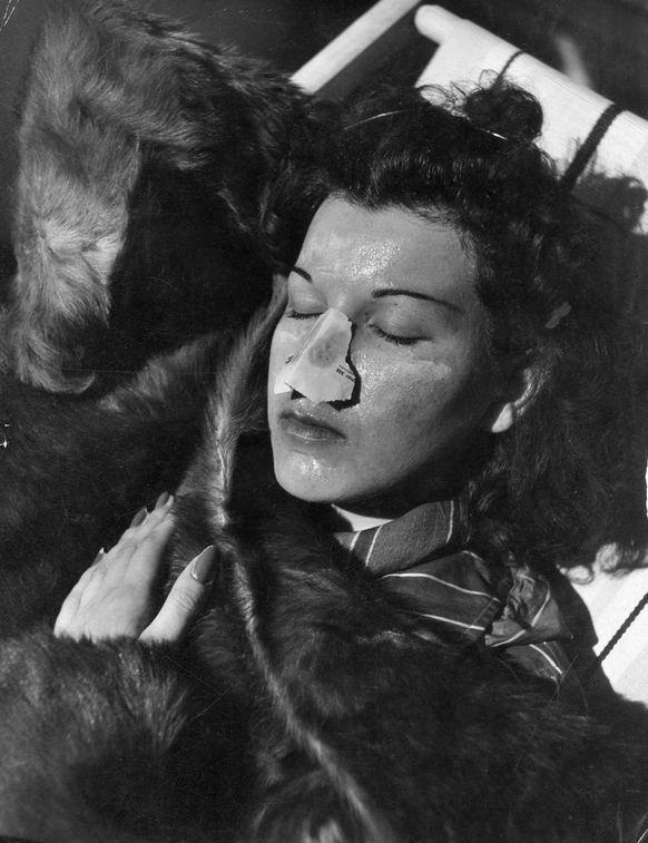 Sunburned noses are a no no on the fashionable ski slopes of St. Moritz, Switzerland. Our model wears a nifty nose protector to keep her nose out of trouble. Date: 1930s PUBLICATIONxNOTxINxUKxFRAxBELx ...