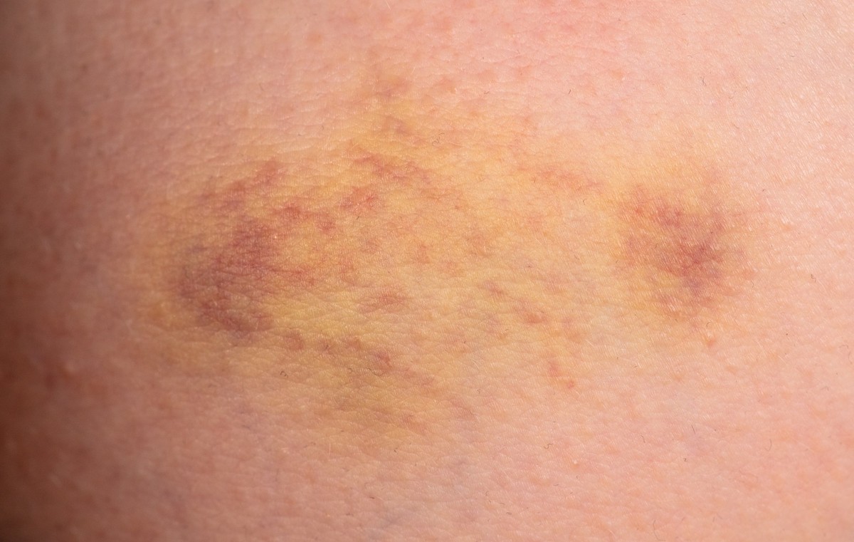 Morsure d'araigéne recluse brune