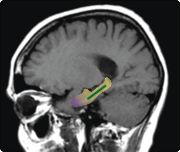 Lage des Gyrus dentatus&nbsp;(grün) im Hippocampus (gelb).&nbsp;