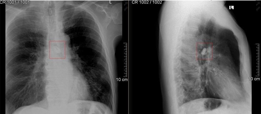 Dbild: st. barbara-klinik hamm-heessen gmbhas Röntgen-Bild zeigt den Fremdkörper in der Lunge.