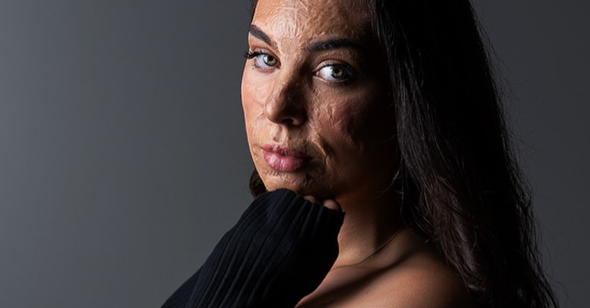 -ich-bin-dankbar-dass-ich-eine-zweite-chance-zum-leben-erhielt-brandopfer-erz-hlt