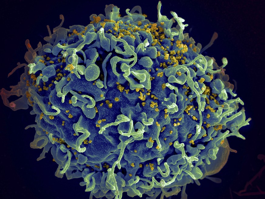 This electron microscope image made available by the U.S. National Institutes of Health shows a human T cell, in blue, under attack by HIV, in yellow, the virus that causes AIDS. The virus specificall ...