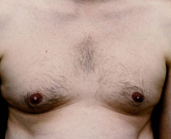 Breast and chest of an adult white male with weight issues, man boobs. Isolated on black background. High quality photo
