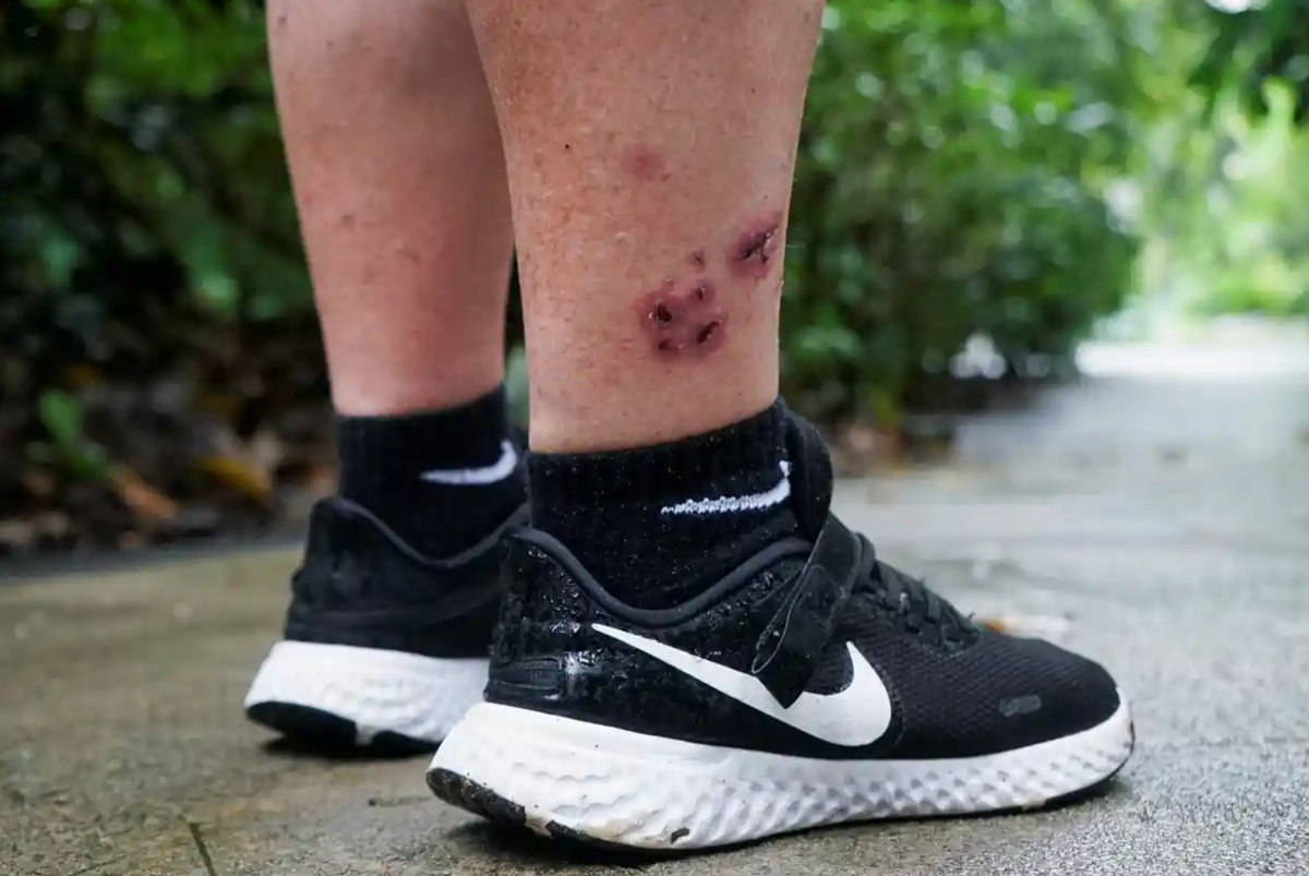 Mit ihren spitzen Zähnen können Otten reichlich Schmerz bereiten – ein in Singapur lebender Brite musste das am eigenen Leib erfahren.