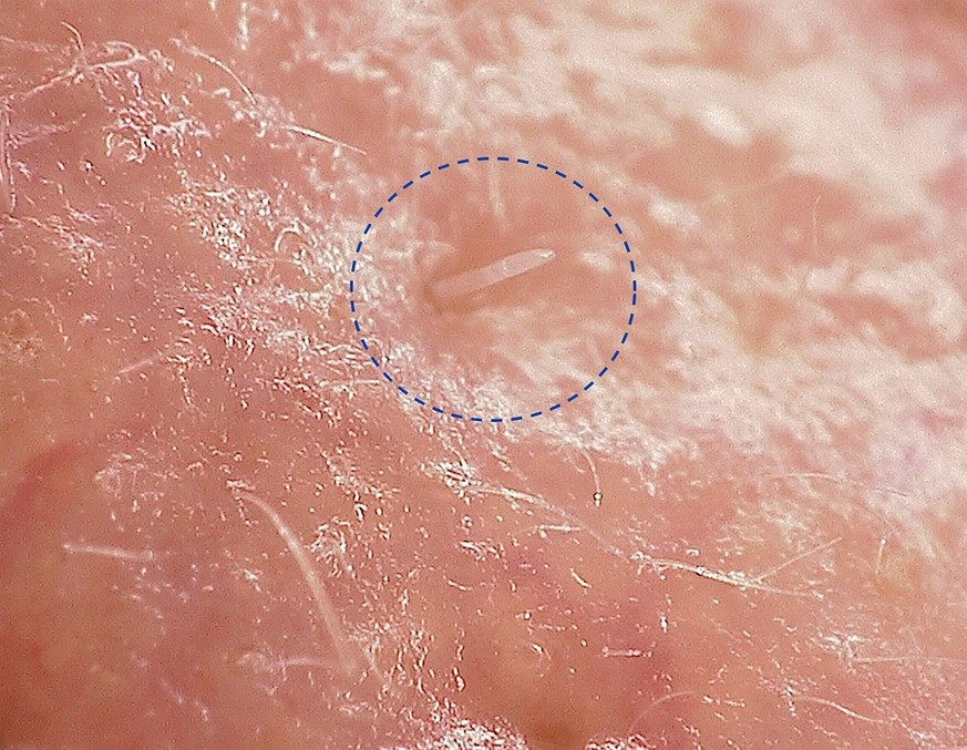 Hinterende einer Haarbalgmilbe (Demodex folliculorum), das aus einer Pore ragt.