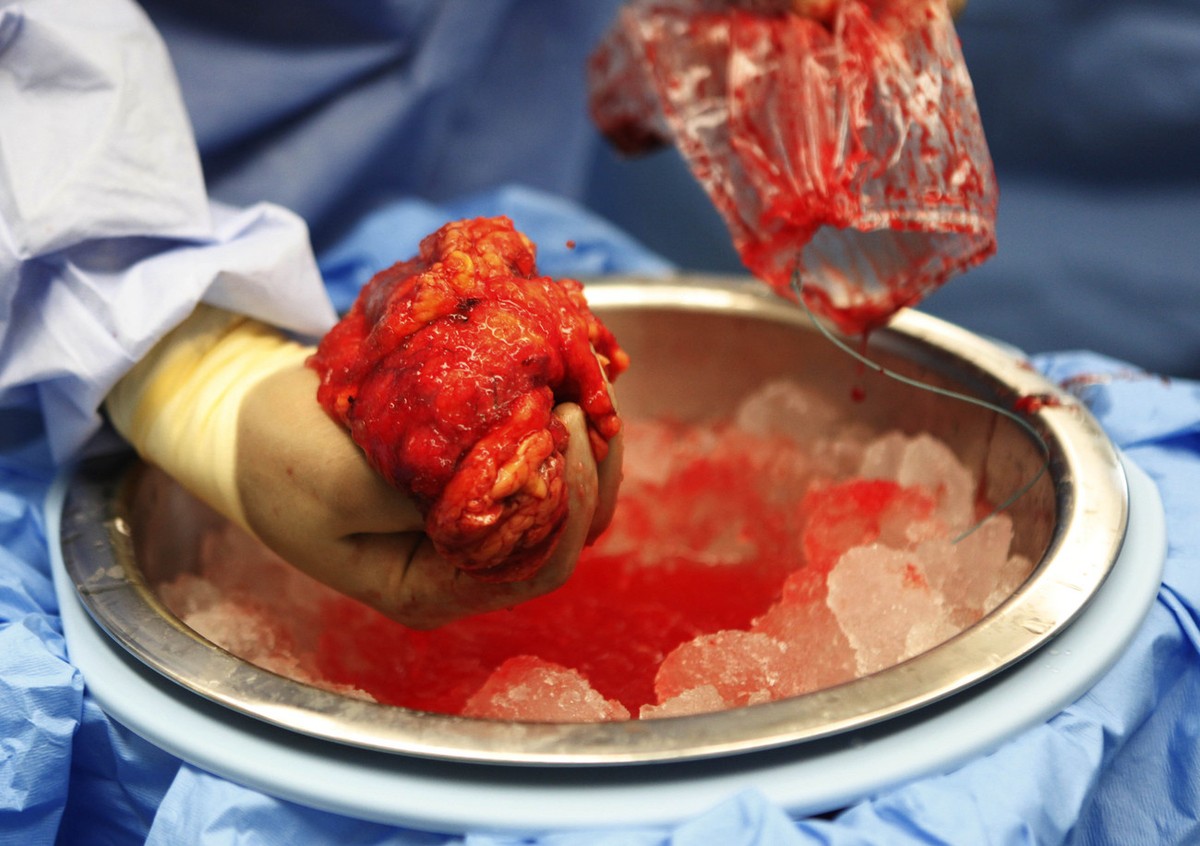 ** HOLD FOR RELEASE UNTIL 12:01 A.M. EST MONDAY, DEC. 14, 2009 ** Dr. Keith Melancon, Georgetown's kidney transplant director, puts the kidney harvested from donor Tom Otten, into an ice-filled b ...