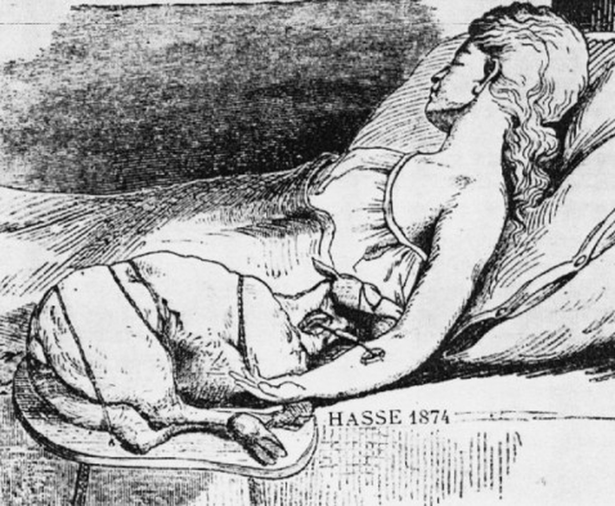 Lammblutübertragung nach O. Hasse, Petersburg 1874.