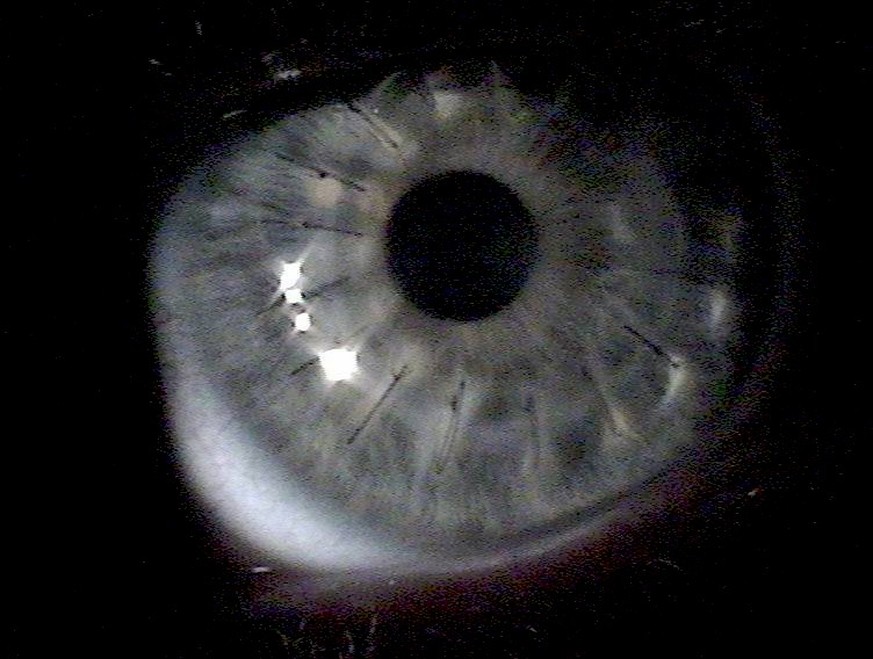 transplantierte Hornhaut (Cornea)
Von David Robinson - Photo given to me by my optometrist., CC BY-SA 3.0, https://commons.wikimedia.org/w/index.php?curid=979240