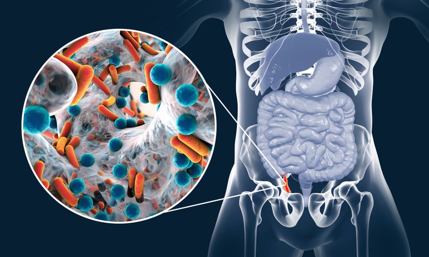 Wurmfortsatz, Appendix: Appendicitis mit Bakterien