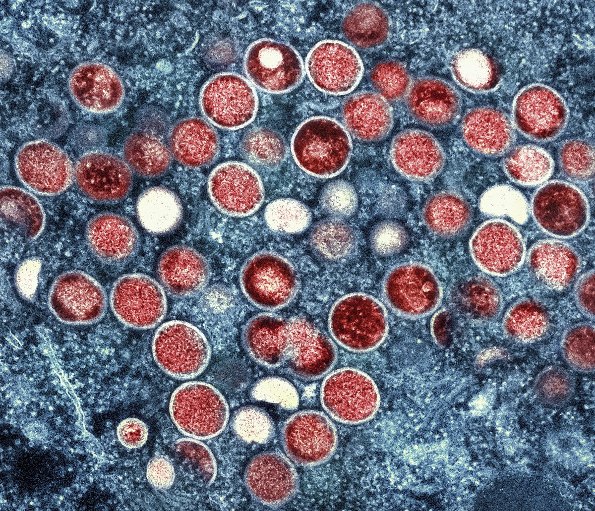 FILE - This image provided by the National Institute of Allergy and Infectious Diseases shows a colorized transmission electron micrograph of monkeypox particles (red) found within an infected cell (b ...