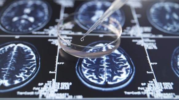 Pipette and petri dish with brain MRI for Alzheimer dementia research property released, ABRF01334