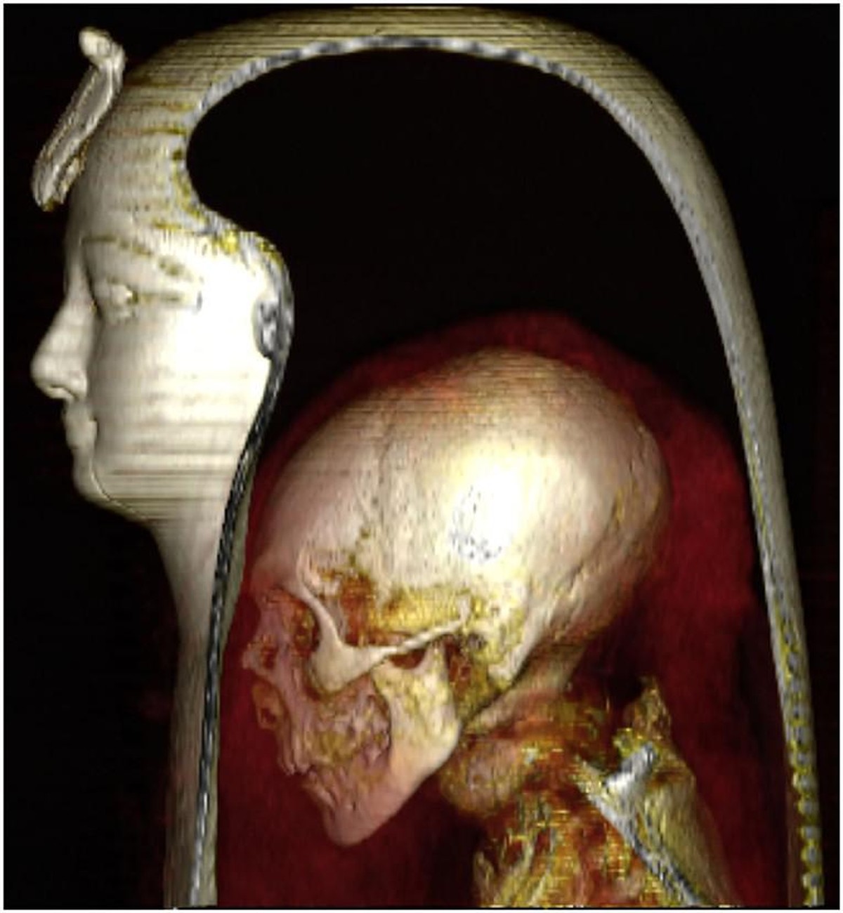 Three-dimensional CT image of the head of the wrapped mummy of Amenhotep I in a left lateral view allows visualization of the component layers: the mask, the head of the mummy, and the surrounding ban ...