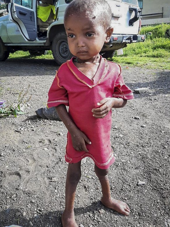 In this photo provided anonymously, a severely malnourished child is seen at the Ayder Referral Hospital, where medicines have almost run out and hospital staffers haven't been paid since June, in Mek ...