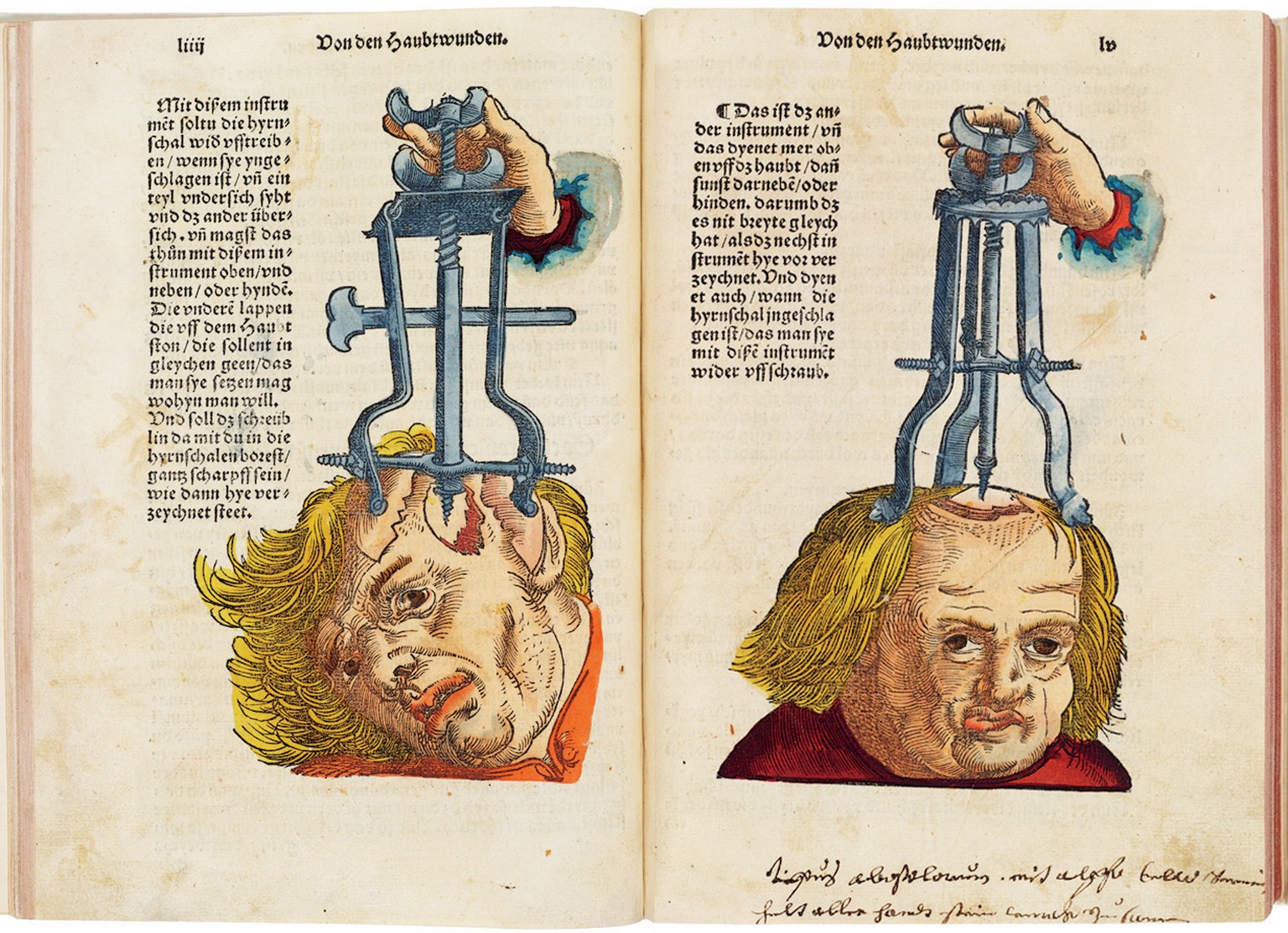 Abbildung aus dem Feldbuch der «Wundarzney» des deutschen Arztes Hans von Gersdorff,&nbsp;1540.