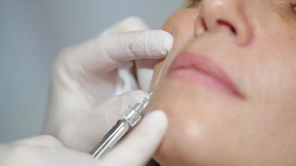 Mit Botox werden die Falten unterspritzt, um jünger auszusehen. Doch mit dem Nervengift ist auch anderes möglich.