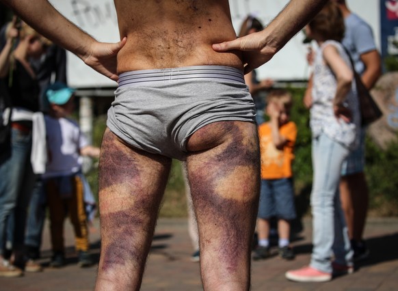 epaselect epa08605447 Artem Pronin shows his bruises which he reportedly got after her was beaten by the police in a detention center during rally in Minsk, Belarus, 15 August 2020. Long-time Presiden ...