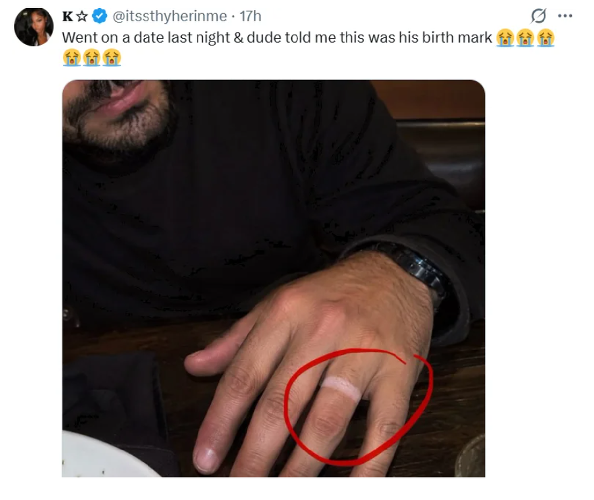 Lustiger Fail: Ehering Abdruck als Geburtsmal