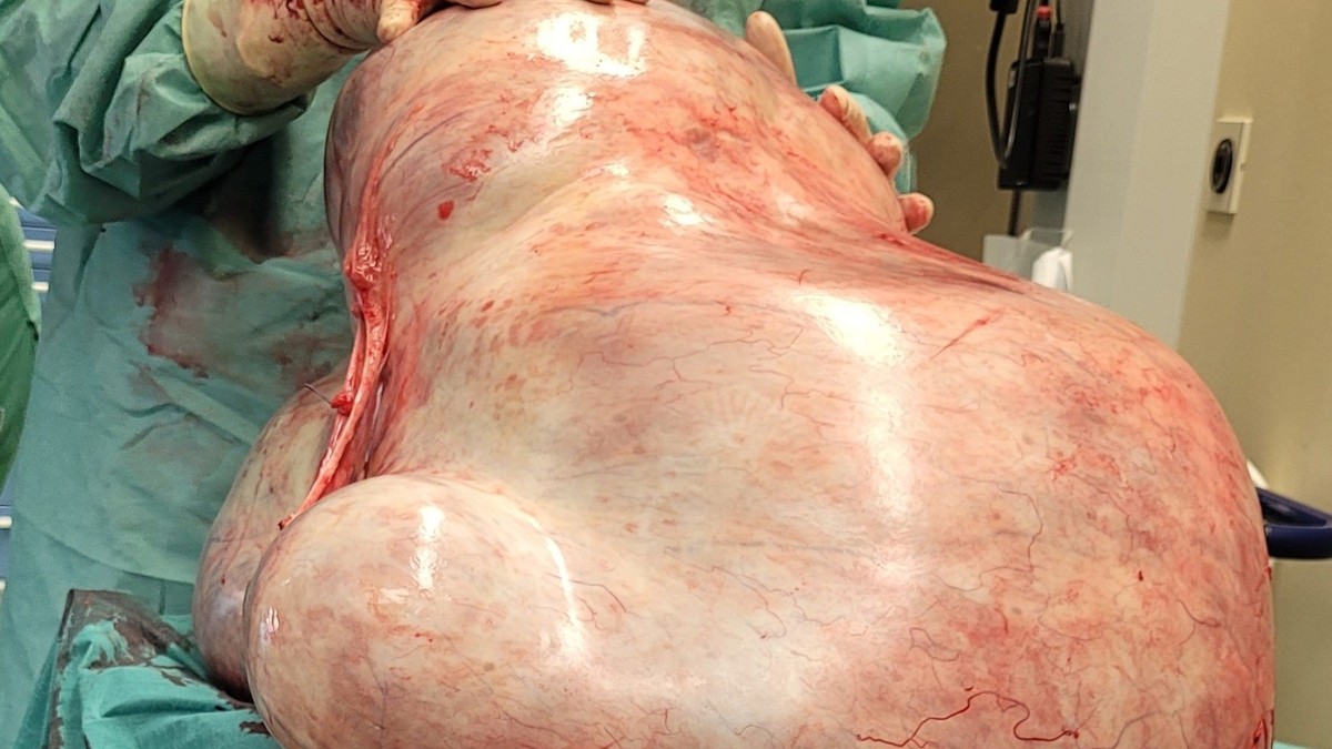 32 kilograms of tumor removed from abdomen of young woman Bill Clinton, Prince Andrew, Michael Jackson: US court releases Epstein papers with names