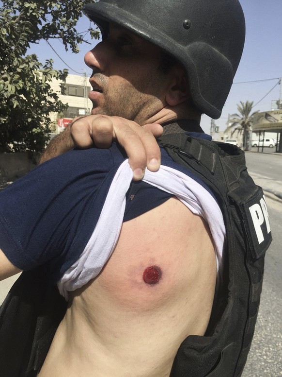 The Associated Press Photographer Majdi Mohammed shows a bruise after he was hit with a rubber bullet while covering clashes between Israeli forces and Palestinians in the town of al Ram, West Bank, S ...