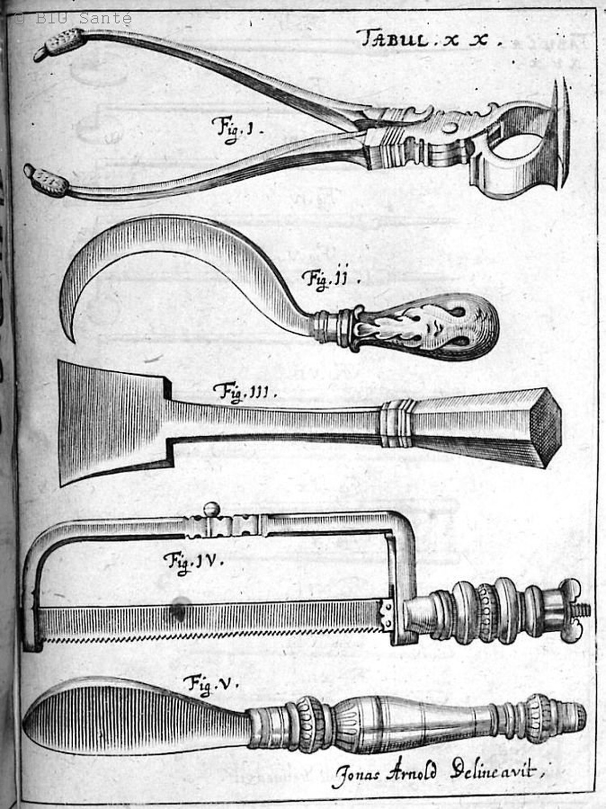 Amputationsinstrumente aus dem «Armamentarium chirurgicum» des deutschen Arztes Johannes Scultetus, 1657.