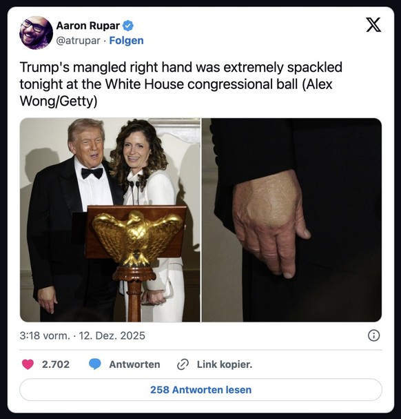 Reaktion bei X auf Trumps ungesund aussehende Hand.