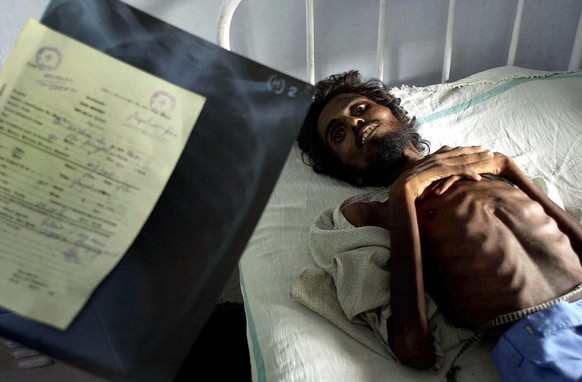 Ein Tuberkulose-Patient wird in einem Krankenhaus im indischen Amritsar am 29. Aug. 2002 von einem Arzt untersucht. Laut Weltgesundheitsorganisation (WHO) fallen jaehrlich weltweit rund zwei Millionen ...