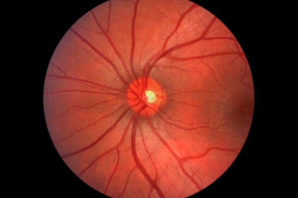 Aufnahme der Retina (Netzhaut) und des Sehnervs des menschlichen Auges.