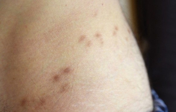Mites, scabies, itch mites, infectious diseases