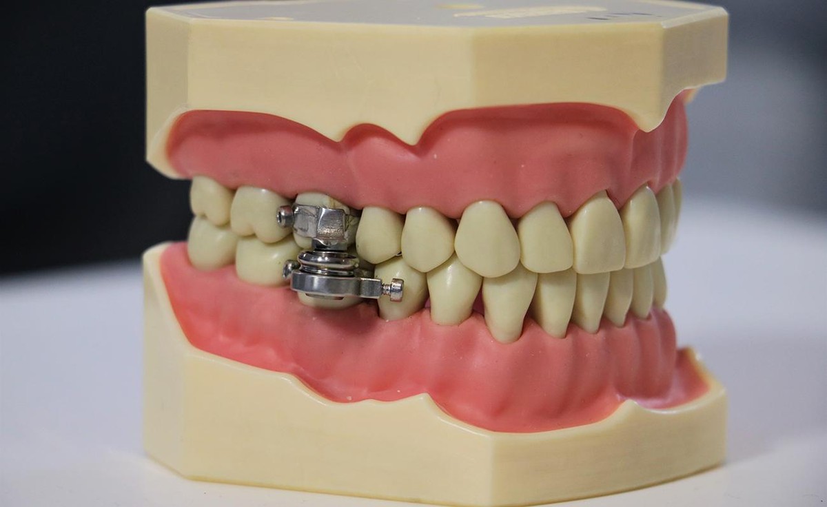 Forschende präsentiert das dentalslim diet tool. eine Kiefersperre, die zu Gewichtsverlust führen soll