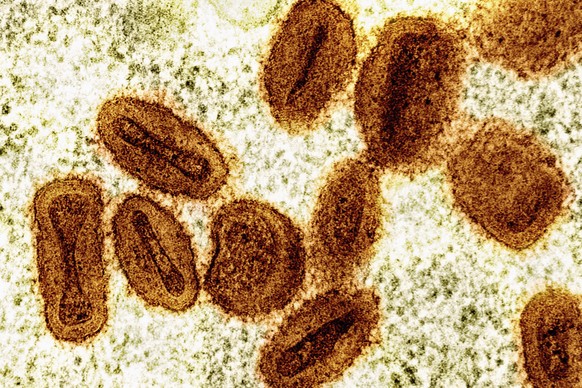 FILE - This colorized electron microscope image provided by the National Institute of Allergy and Infectious Diseases in 2024 shows Mpox virus particles, orange, found within infected cells, green. (N ...