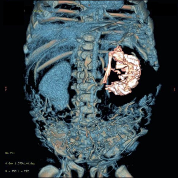 Fall eines zweieinhalb Monate alten, indischen Jungen. Die zusammengerechneten CT-Schichtaufnahmen zeigen neben der Wirbelsäule des Kindes eine helle Struktur, der Fötus.<br data-editable="remove">