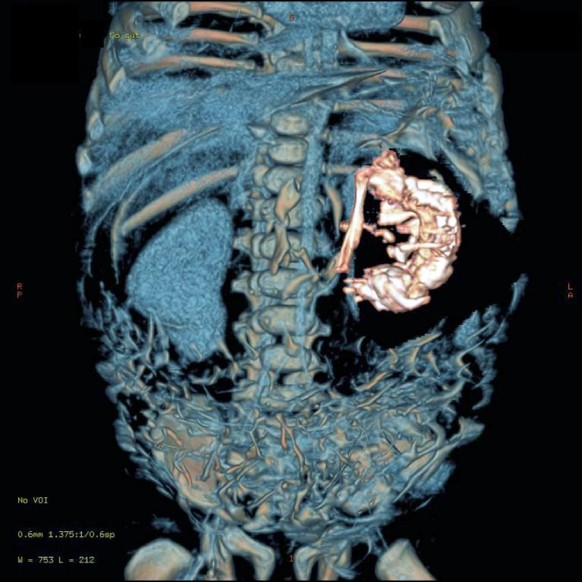 Fall eines zweieinhalb Monate alten, indischen Jungen. Die zusammengerechneten CT-Schichtaufnahmen zeigen neben der Wirbelsäule des Kindes eine helle Struktur, der Fötus.