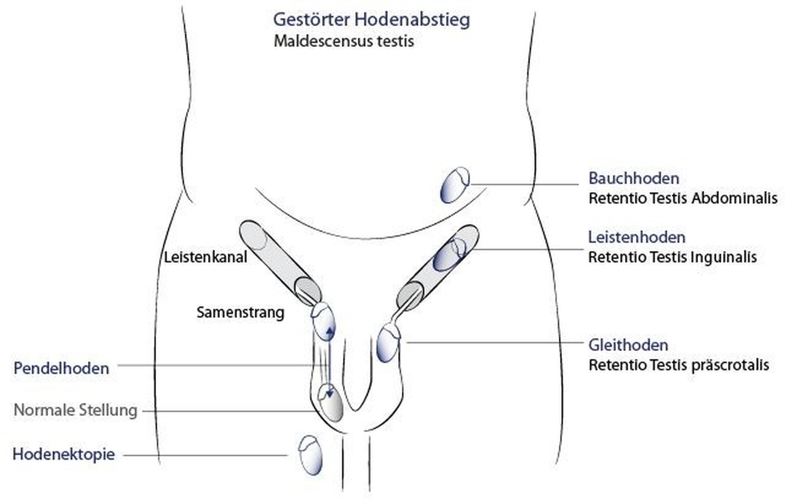 Ungefähr 3% der reifen männlichen Neugeborenen und etwa 30 % der Frühgeborenen (aber 100 % aller männlichen Frühgeburten mit einem Geburtsgewicht von weniger als 900 Gramm) weisen noch eine ein- oder  ...