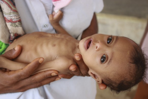 In this Sunday, June 14, 2020 photo, seven-month-old Issa Ibrahim Nasser is brought to a clinic in Deir Al-Hassi, At seven months old, Issa weighs only three kilos. Like him, hundreds of children suff ...