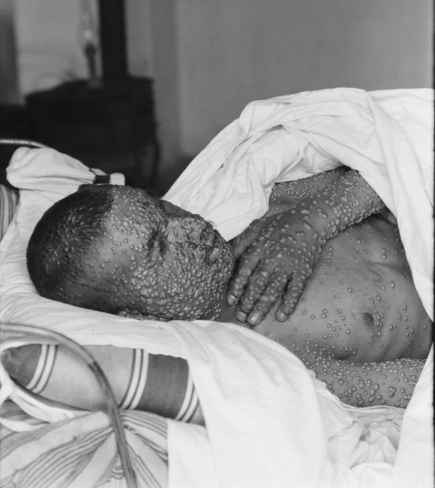 An Pocken erkranktes Kind in Palästina, 20er-Jahre des 20. Jahrhunderts.