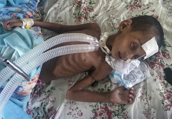 In this photo provided anonymously, Rahwa Mehari, 4, who first suffered from malnutrition according to her father and medical records show then developed a cerebral tuberculoma, is treated at the Ayde ...