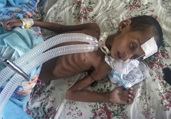 In this photo provided anonymously, Rahwa Mehari, 4, who first suffered from malnutrition according to her father and medical records show then developed a cerebral tuberculoma, is treated at the Ayde ...