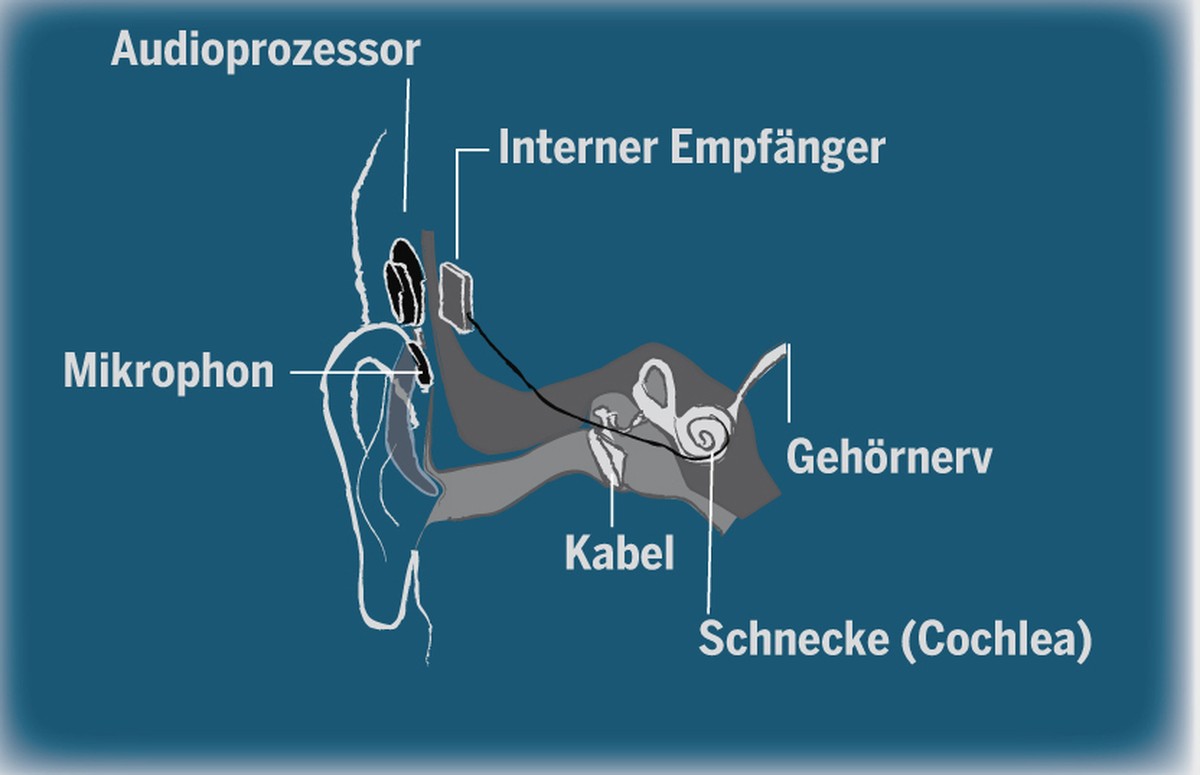 Dieses Implantat für Gehörlose wurde bereits in den 1960er-Jahren entwickelt. Ein Mikrofon hinter dem Ohr nimmt die Schallschwellen von Sprache und Geräuschen auf. Diese werden von einem implantierten ...