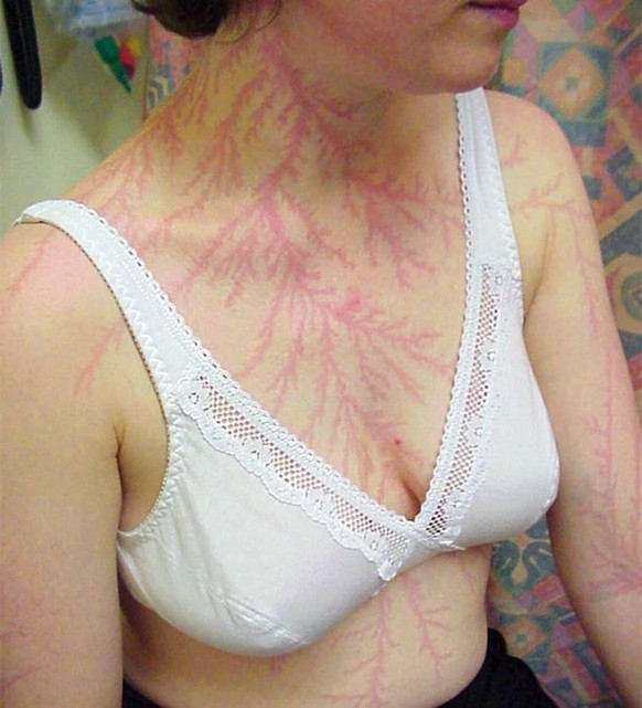 Lichtenberg-Figur auf der Haut einer Frau, die vom Blitz getroffen wurde.