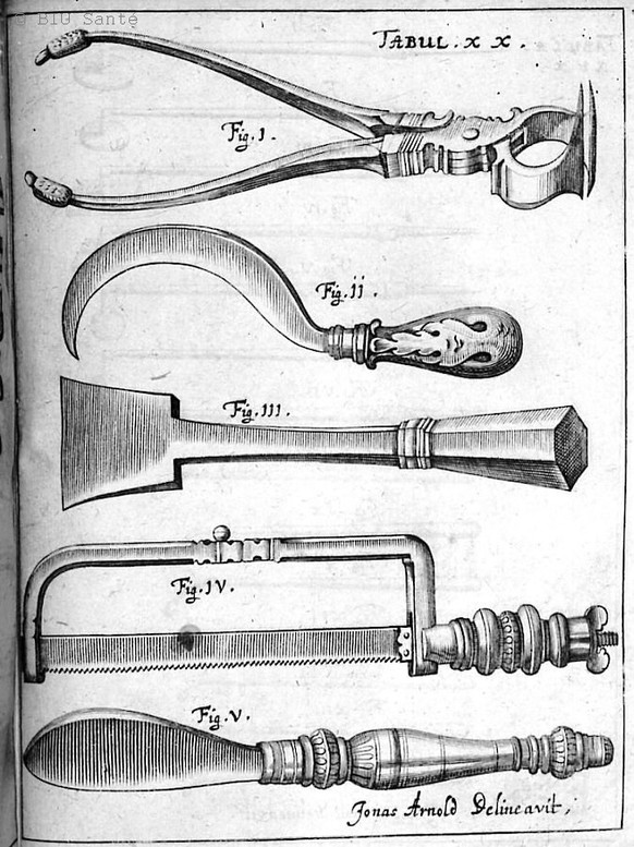Amputationsinstrumente aus dem «Armamentarium chirurgicum» des deutschen Arztes Johannes Scultetus, 1657.