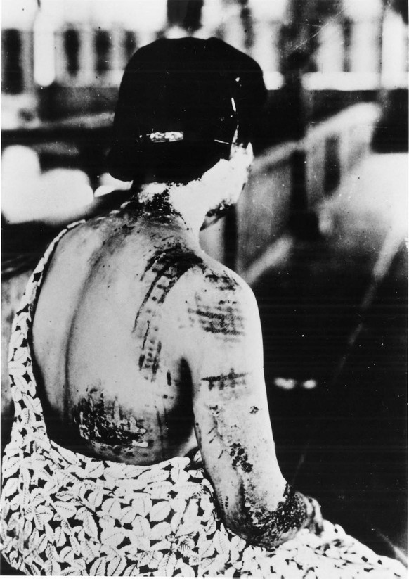 epa02271798 (FILES) A handout photo dated 15 August 1945 of an A-bomb victim with severe burns. The black colored designs of the women&#039;s kimono absorbed and radiated intense heat from the atomic  ...