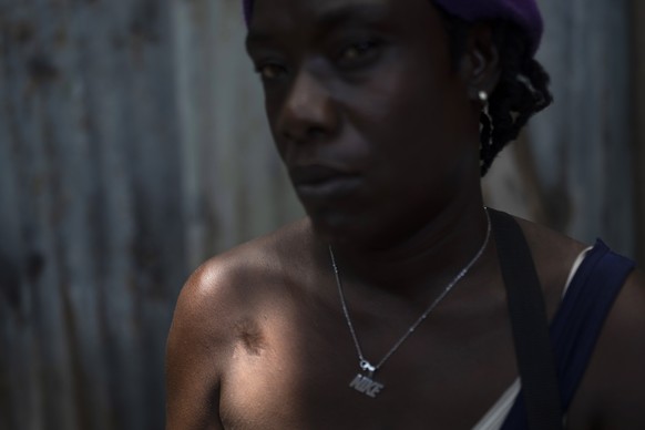 A ray of light illuminates a bullet wound on Rose Dufond&#039;s right shoulder as she poses for a picture at a shelter in Delmas, in Port-au-Prince, Haiti, Sunday, June 4, 2023. Dufond says she was ni ...