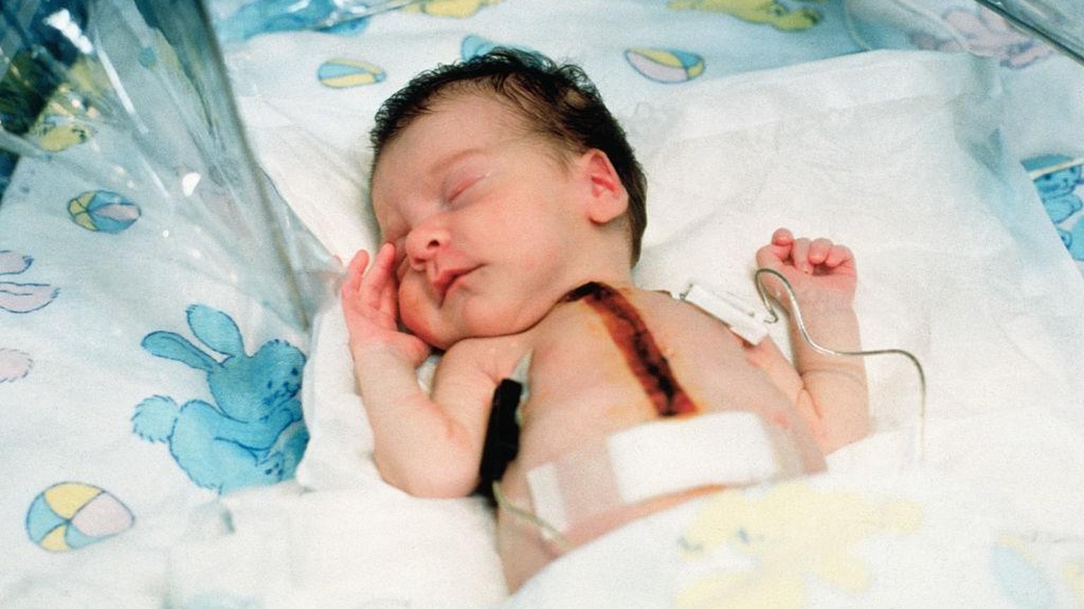 Baby Fae After Heart Transplant
Baby Fae, the world&#039;s first infant to receive a baboon heart transplant, sleeps at Loma Linda University Medical Center. Doctors at Loma Linda said they were &quot ...