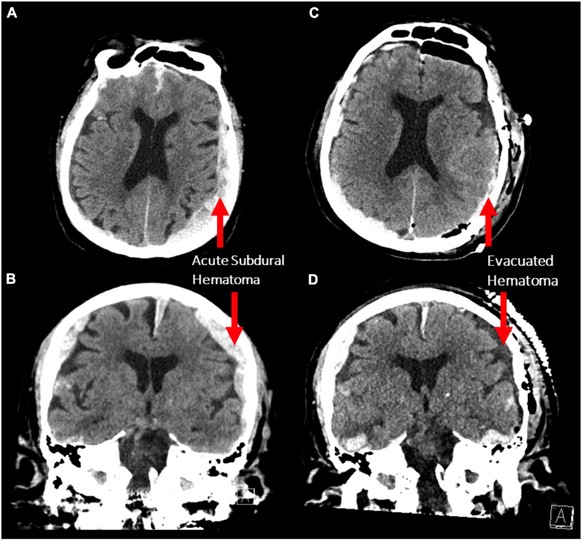 Figure 1. (A,B) Axial and coronal non-contrast CT scans demonstrating bilateral acute subdural hematoma with a larger mass effect on the left side (maximum thickness 1.5 cm). (C,D) The same scan seque ...