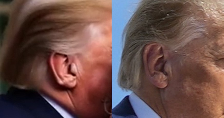 Donald Trump's ears, fake vs real