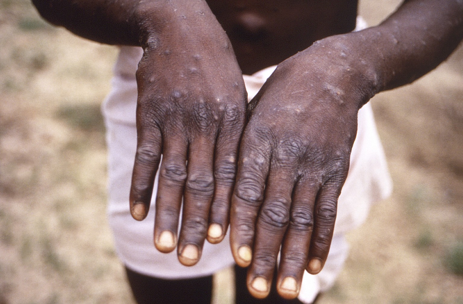 FILE - This 1997 image provided by the CDC during an investigation into an outbreak of monkeypox, which took place in the Democratic Republic of the Congo (DRC), formerly Zaire, depicts the dorsal sur ...