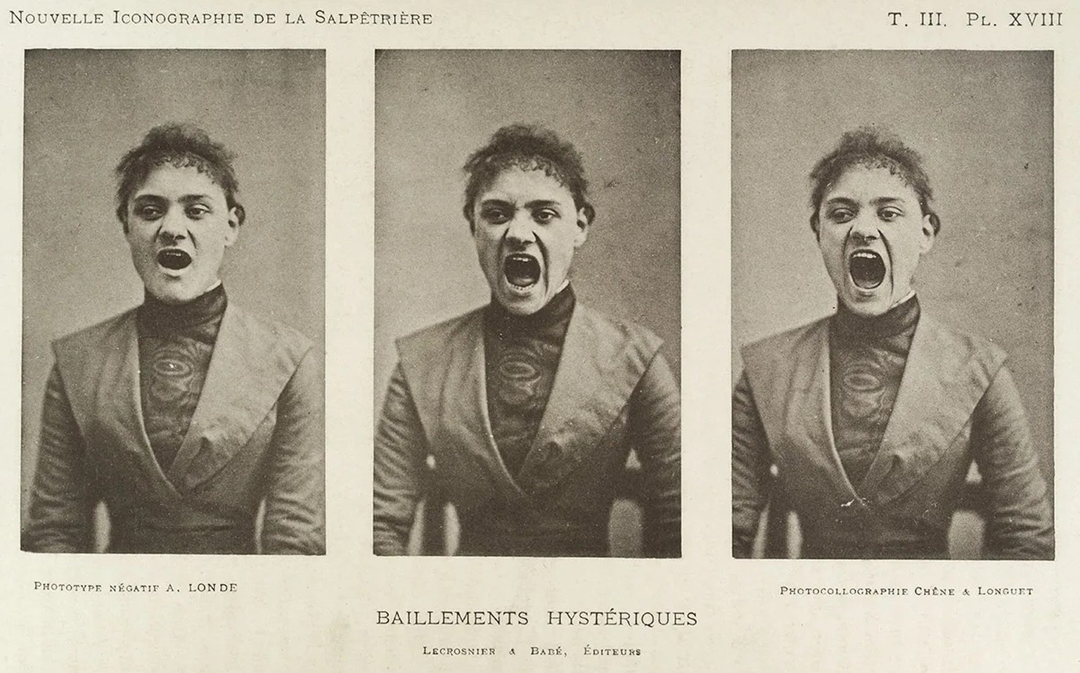 Diese Frau soll beim Gähnen Symptome von Hysterie zeigen. Bilder aus der Pariser Klinik Salpêtriere, eine der bekanntesten psychiatrischen Kliniken im 19. Jahrhundert.
https://commons.wikimedia.org/wi ...