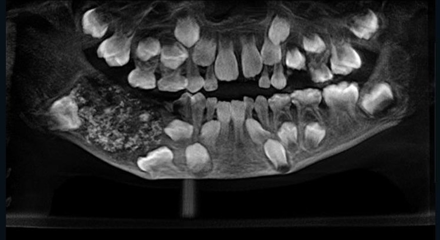 Da hilft selbst die beste Zahnspange nichts mehr: Ein Siebenjähriger hatte 526 Zähne in seinem Gebiss.