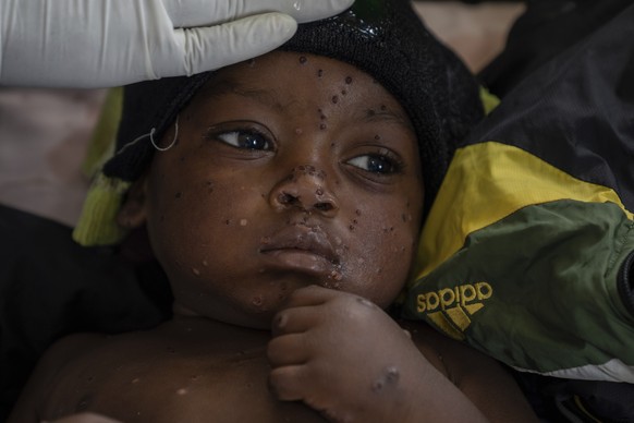 FILE - 2 year old Emile Miango, who has mpox, lies in a hospital, in Kamituga, South Kivu province, Sept. 4, 2024, which is the epicenter of the world&#039;s latest outbreak of the disease in eastern  ...